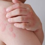 Is Histamine To Blame For Headache Hives Heartburn Fb.jpg