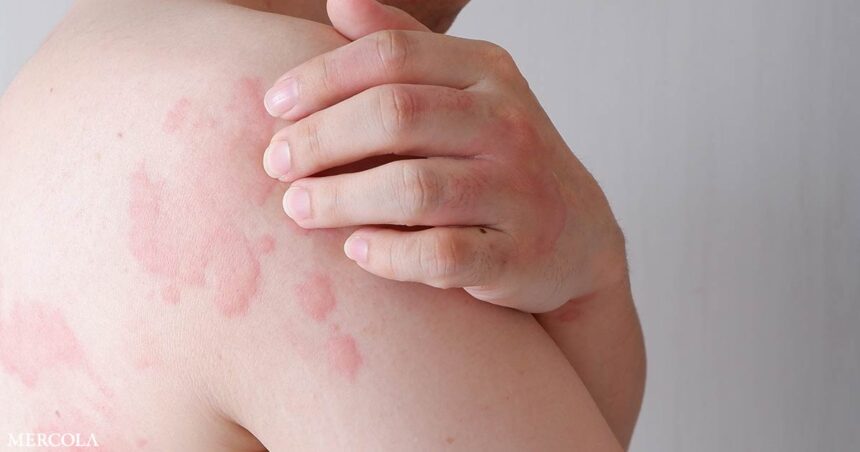 Is Histamine To Blame For Headache Hives Heartburn Fb.jpg